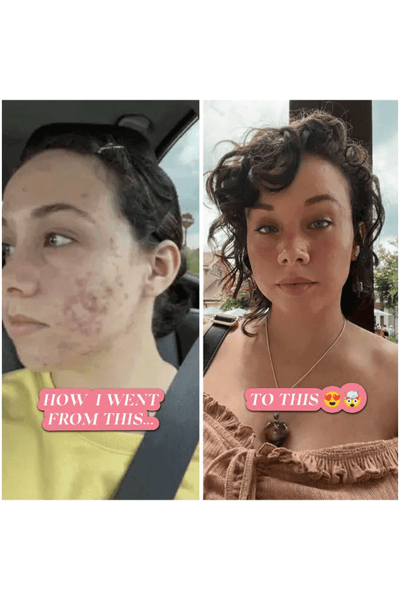 The Spoiled Mama Pregnancy Acne Treatment Kit - SwagglyLife Home & Fashion